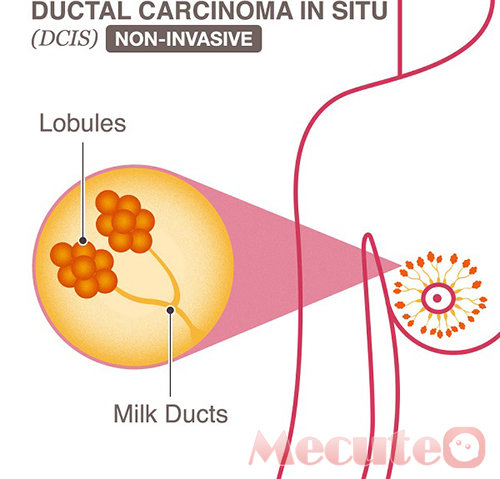 Ảnh 2 của Ductal Carcinoma In Situ